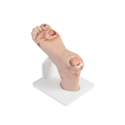 轻症糖尿病足模型