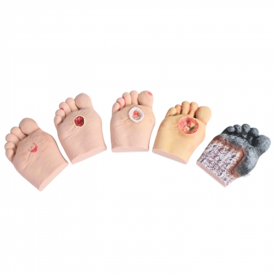 5级程度糖尿病足模型